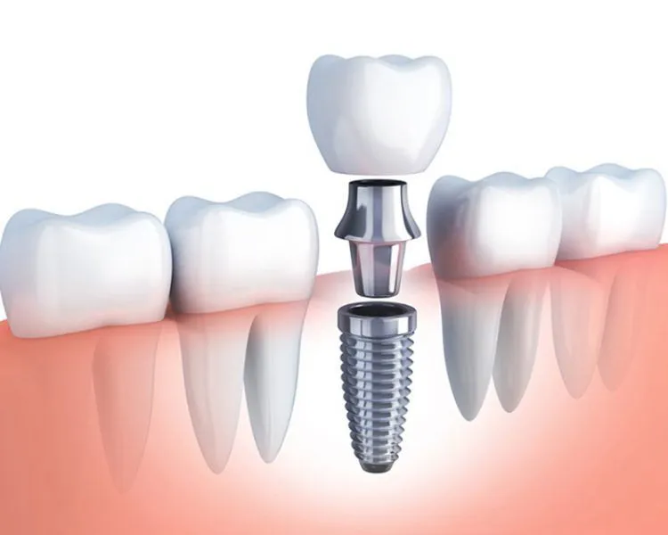 Cấy ghép implant - Chỉ định trường hợp mất răng