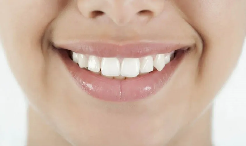 Phục hình răng khểnh bằng răng sứ (Bọc sứ)