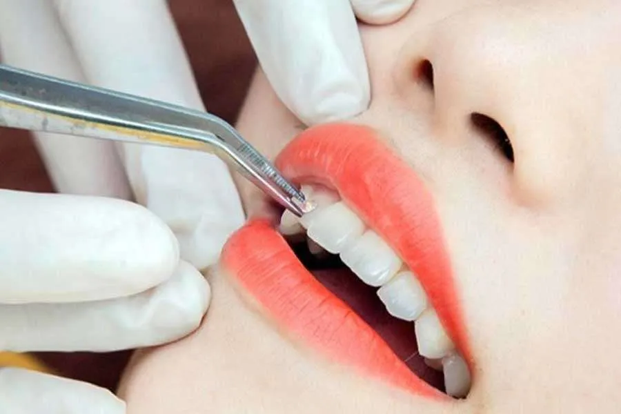 Đắp răng khểnh bằng vật liệu composite phổ biến