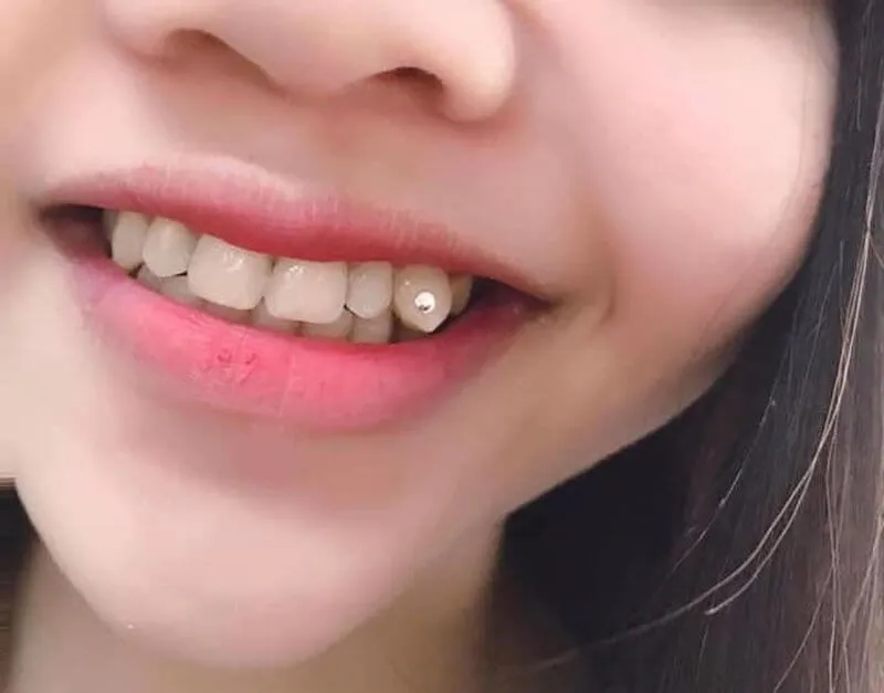 Đắp răng khểnh giữ được bao lâu?