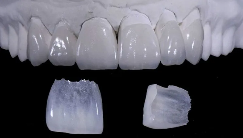 Mặt dán sứ Veneer Diamond