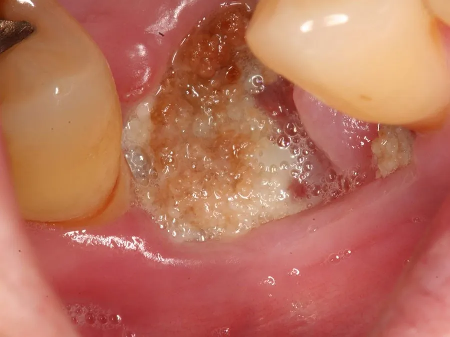 Dấu hiệu nhiễm trùng sau khi nhổ răng khôn