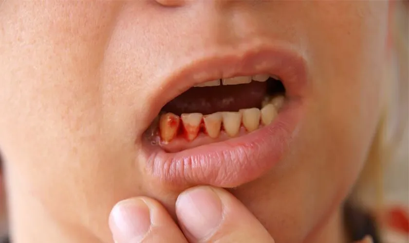 Dấu hiệu chảy máu kéo dài và lâu sau khi nhổ răng khôn