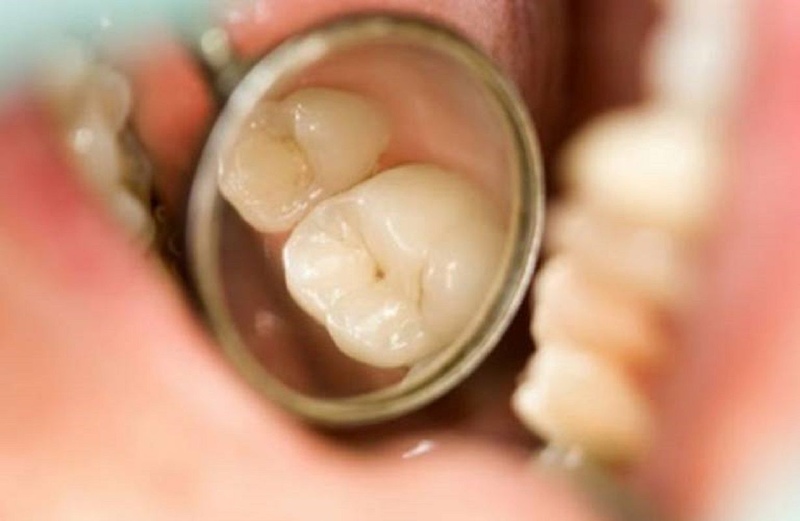 Dấu hiệu sâu răng nhẹ thường gặp