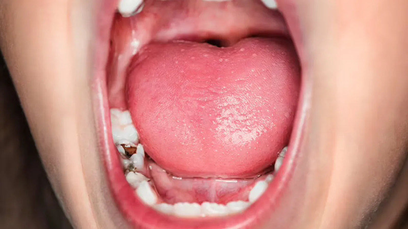 Các loại sâu răng nhẹ thường gặp