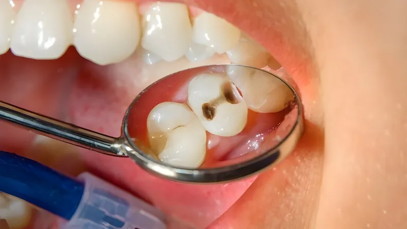 Tác hại của tình trạng sâu răng nhẹ