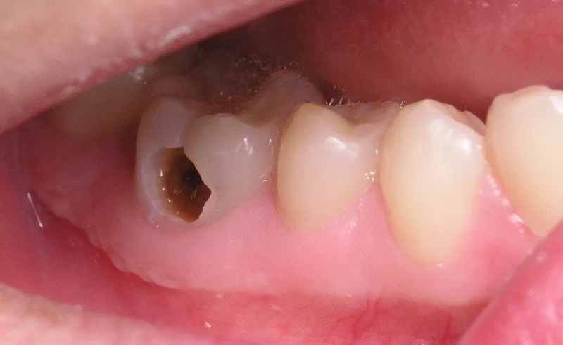 Phương pháp điều trị sâu răng nhẹ tại nha khoa