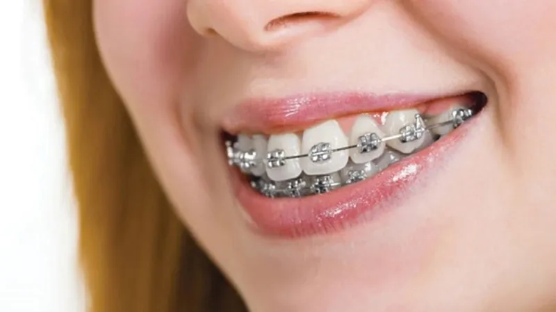Dụng cụ niềng răng tại nhà có hiệu quả không?