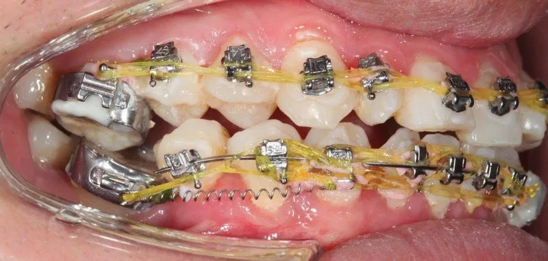 Các loại dụng cụ niềng răng tại nhà hiện nay - Mắc cài tự chế
