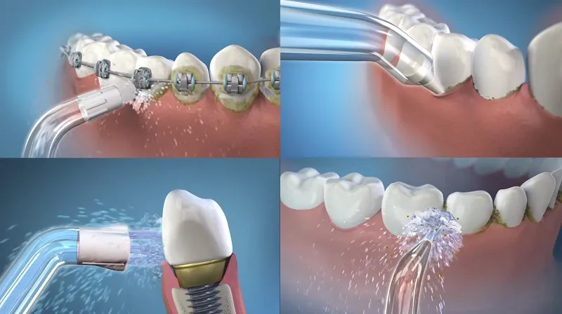 Dùng máy tăm nước để vệ sinh răng niềng