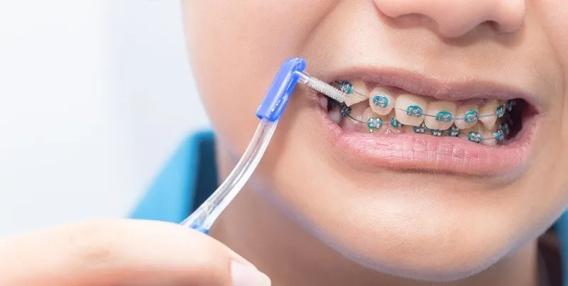 Dùng bàn chải góc để vệ sinh răng niềng