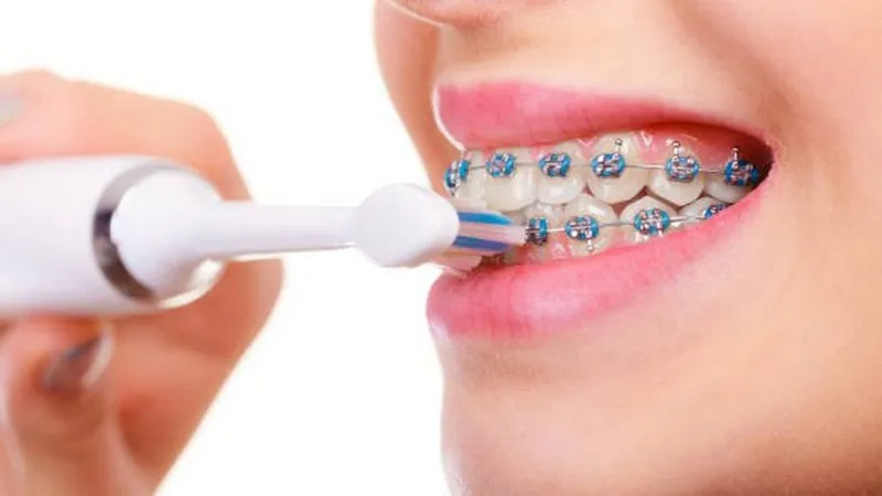 Lưu ý khi vệ sinh răng miệng khi niềng răng