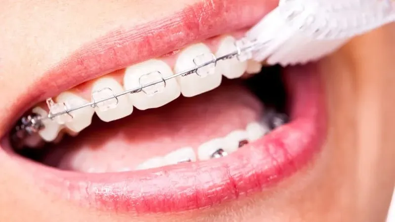 Một số lưu ý về chế độ ăn uống khi niềng răng