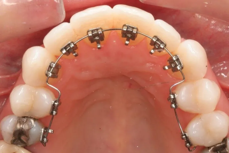 Tại sao việc vệ sinh răng miệng khi niềng răng lại quan trọng?