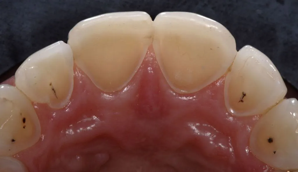 Mặt dán sứ Veneer Lingual/Palatal