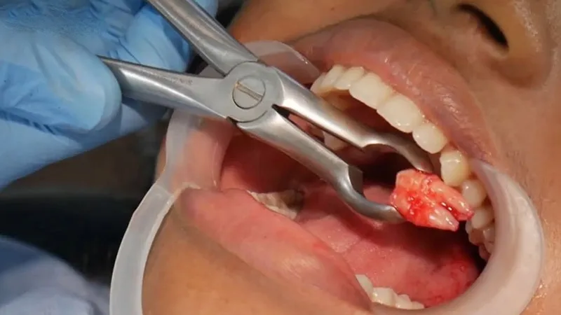 Biến chứng khi không thực hiện cách vệ sinh lỗ răng khôn