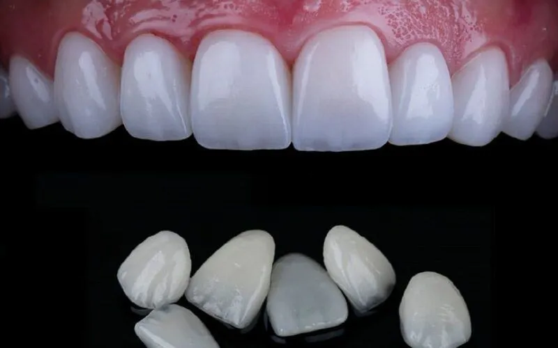 Mặt dán sứ Veneer Emax