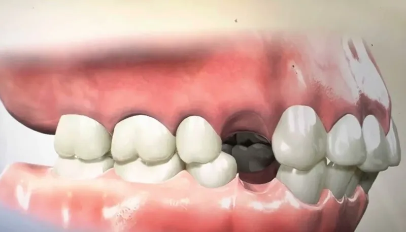 Nhổ 8 cái răng để niềng là răng nào?