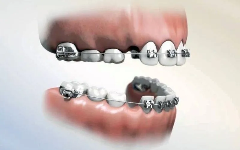 Nhổ 8 cái răng để niềng là răng nào?