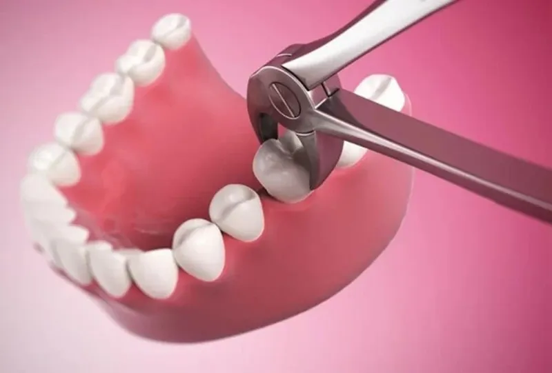 Nhổ 8 cái răng để niềng trong trường hợp nào?