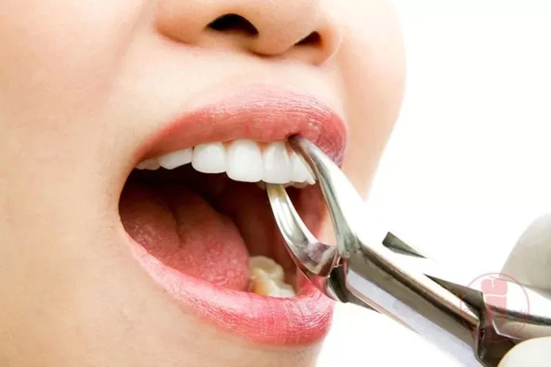 Nhổ 8 cái răng để niềng có nguy hiểm không?