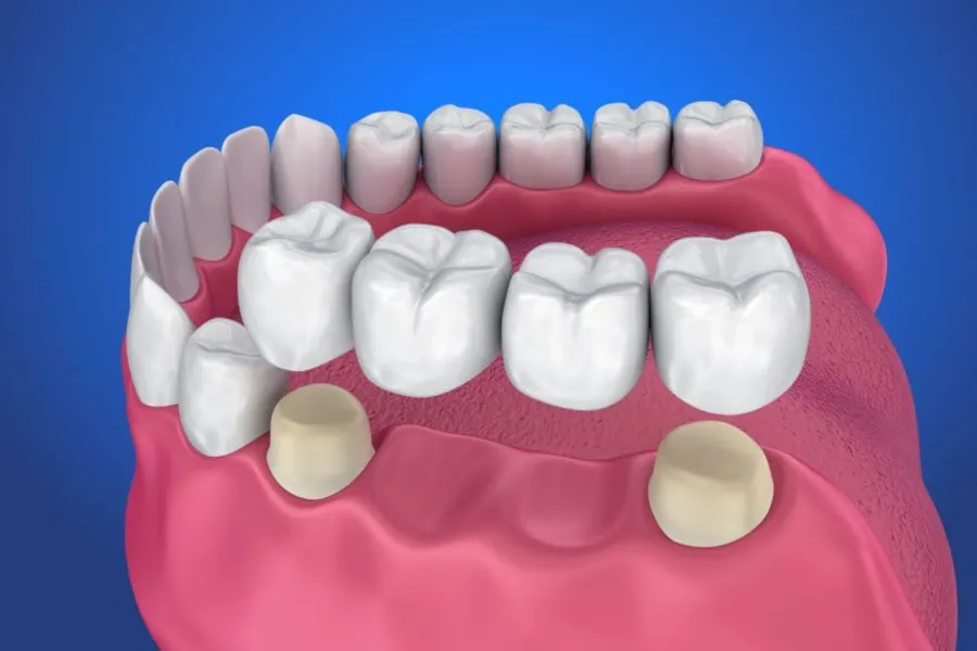 Bước 4: Lắp răng sứ khểnh cố định và kiểm tra lại