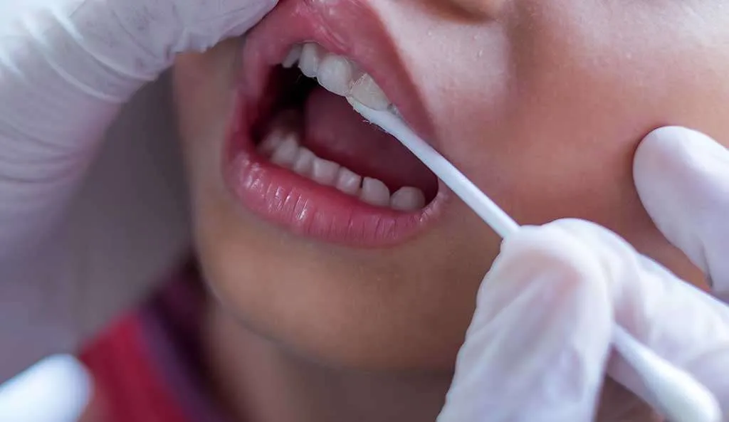 Điều trị sâu răng bằng Fluoride