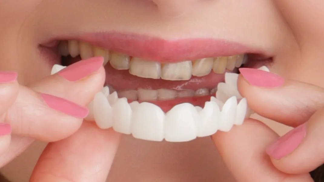 Mặt dán sứ Veneer Snap-on Veneer/ Removable