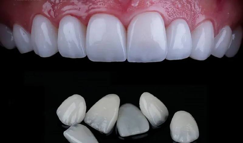 Mặt dán sứ Veneer Zirconia