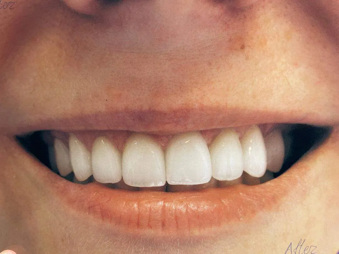 Mặt dán sứ Lumineer Veneer