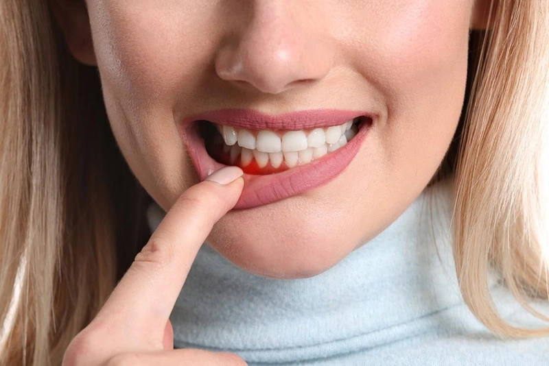Những tác nhân gây ra hiện tượng chảy máu chân răng