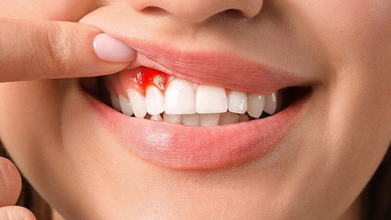 Chảy máu chân răng là gì?