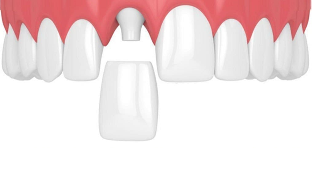 Bước 5: Gắn mão bọc răng sứ cho 2 răng cửa bị hô