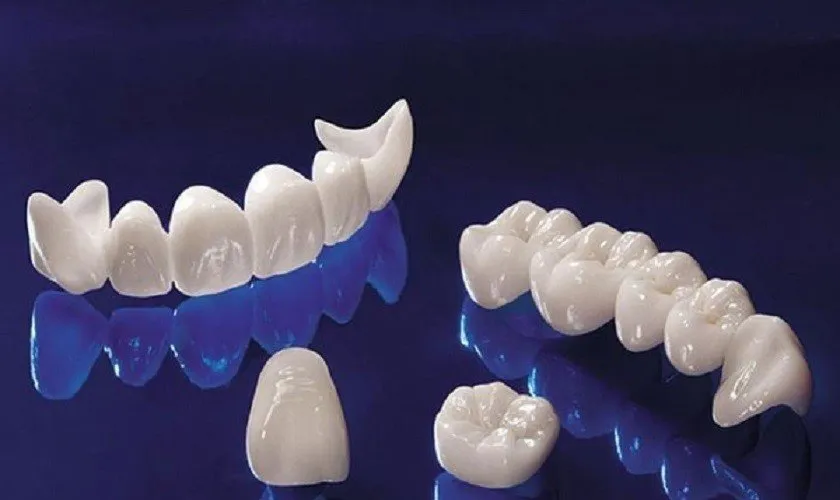 Răng toàn sứ (All-Ceramic Crowns)