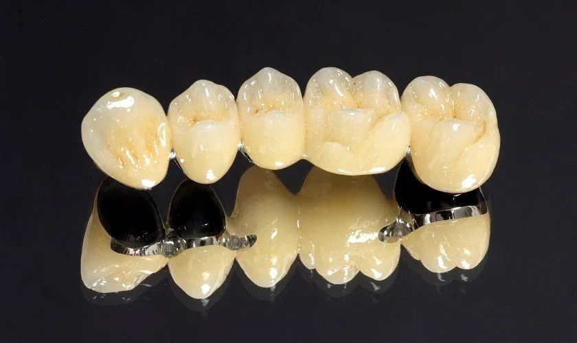 Răng sứ kim loại (Metal-Ceramic Crowns)