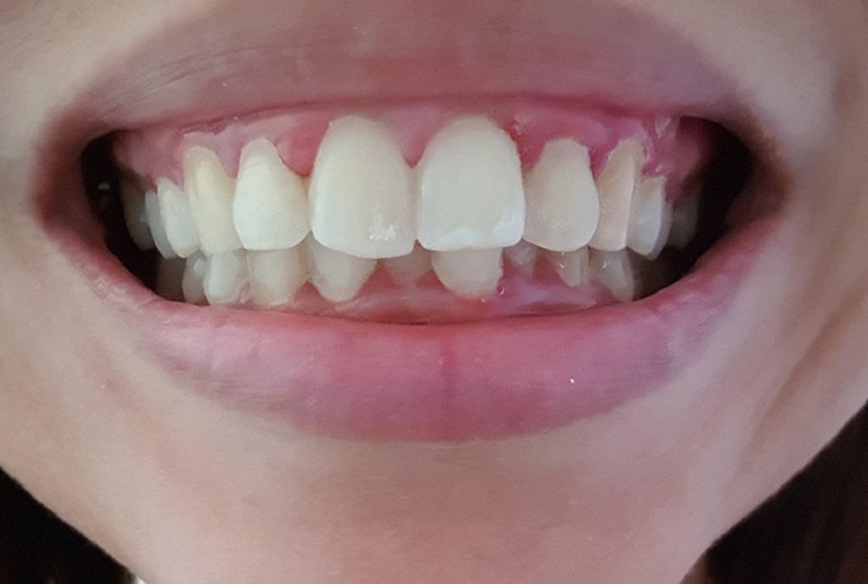 Lợi ích của việc bọc răng sứ cho 4 răng cửa bị hô