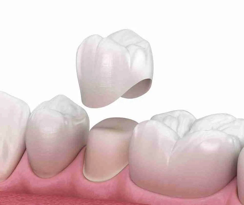 Bước 5: Gắn mão sứ và kiểm tra khớp cắn