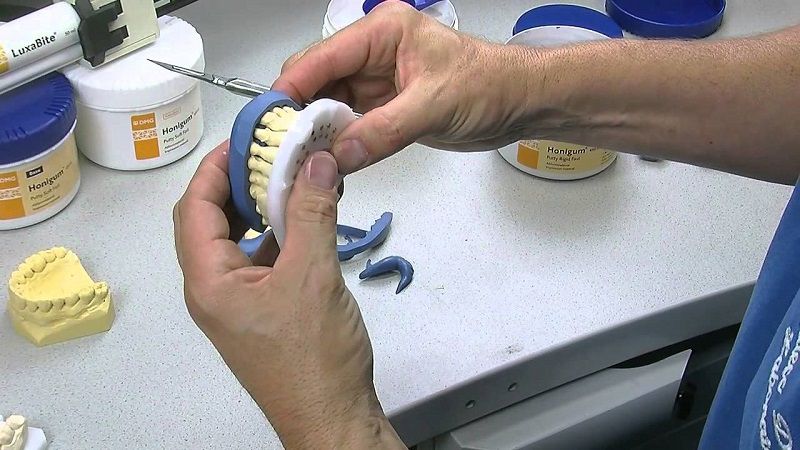 Bước 3: Lấy dấu răng và gắn răng tạm