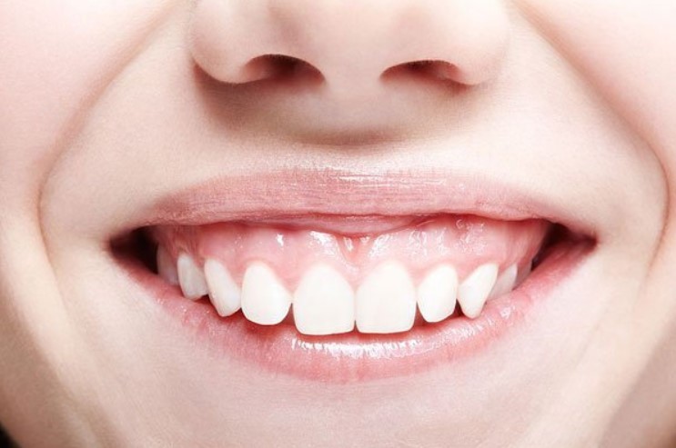 Bọc răng sứ cho 4 răng cửa bị hô là gì?