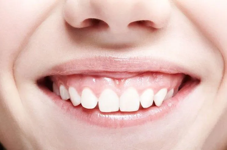 Bọc răng sứ cho 4 răng cửa bị hô là gì?