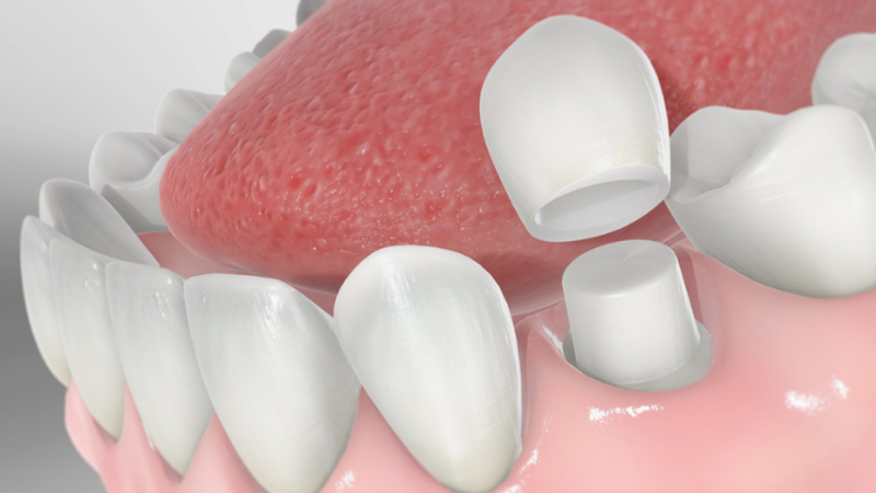 Gắn thử và cố định mão răng sứ