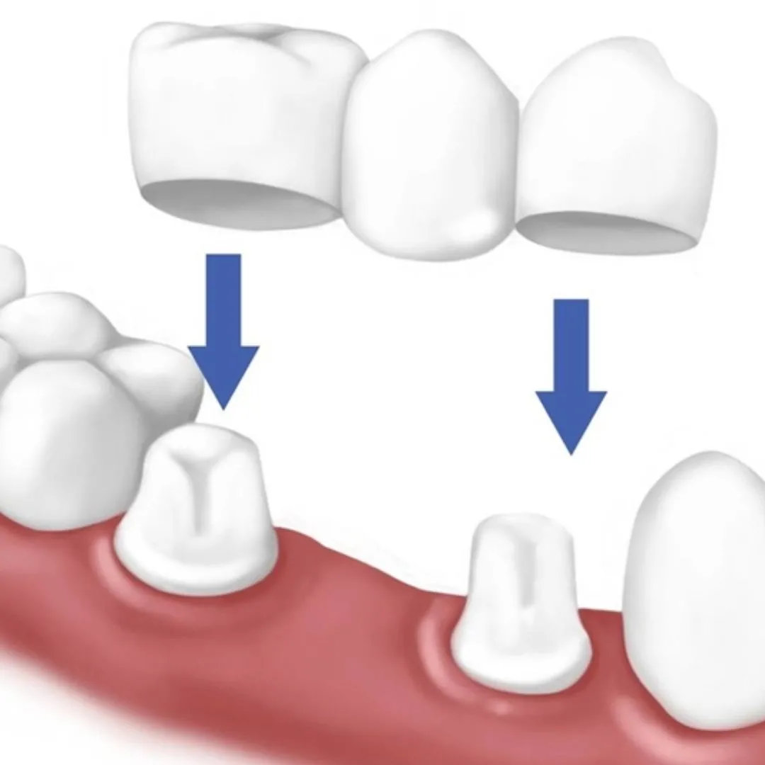 Lợi ích của bọc răng sứ đối với răng hô