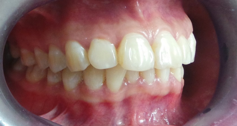 Răng hô hở lợi (Cười hở nướu)