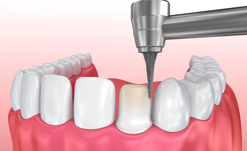 Gây tê, mài cùi răng và điều chỉnh khớp cắn