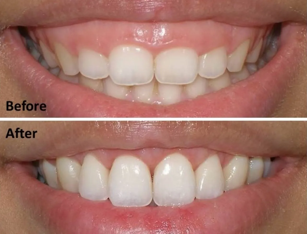 Bọc răng sứ có hết hô không?