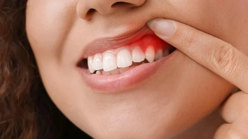 Dấu hiệu của việc bọc răng sứ khó nhai