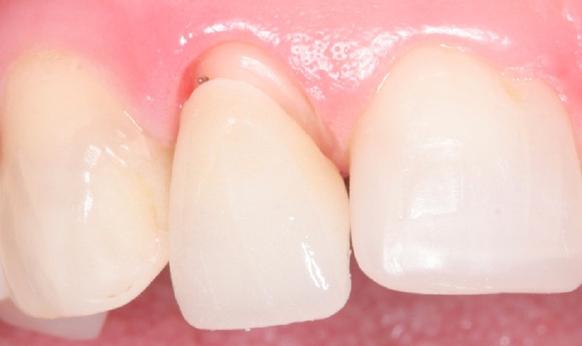 Mão sứ bị cộm do sai lệch về tỉ lệ và kích thước