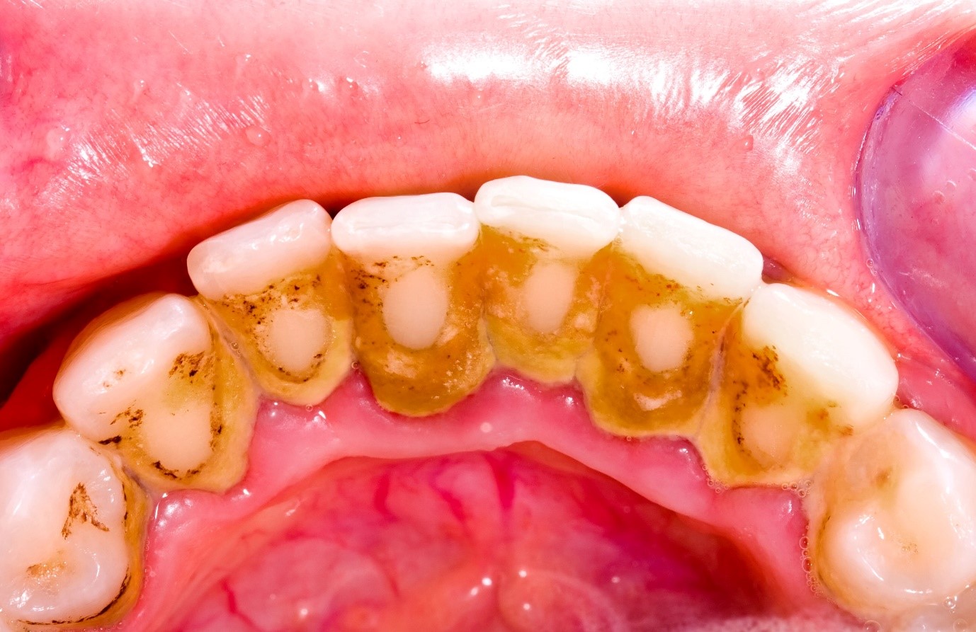 Cạo vôi răng quá kỹ trước khi bọc răng sứ