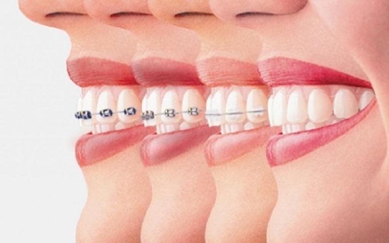 Kéo cụm 4 răng cửa hàm dưới