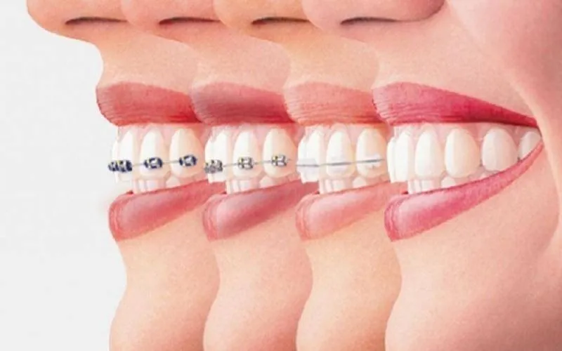 Kéo cụm 4 răng cửa hàm dưới